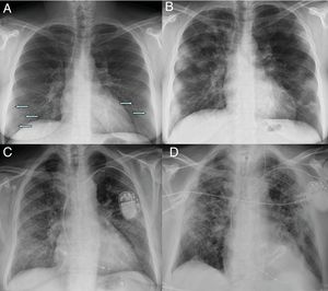 Radiografía inicial (A) y a los 12 días (B) en paciente con COVID-19 y enfermedad moderada. En la radiografía inicial se aprecian opacidades sutiles “en vidrio deslustrado” de localización periférica en campos pulmonares inferiores (flechas). A los 12 días, se observan consolidaciones multifocales de predominio periférico. Radiografía inicial (C) y a los 20 días (D) de otro paciente con COVID-19 y enfermedad moderada, en la que se observan inicialmente opacidades “en vidrio deslustrado” en bases y región periférica de campos medios y superiores, que progresan a un patrón alveolointersticial grosero que predomina en la región periférica de campos medios y superiores.