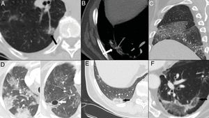 Hallazgos tardíos. A y B) Dilatación vascular, con aumento focal en el calibre de arterias subsegmentarias en el seno de las opacidades pulmonares. C) Engrosamiento pleural evidente a nivel de cisuras mayor y menor derechas. D) Resolución de los focos consolidativos que evolucionan a opacidades “en vidrio deslustrado” en la fase tardía y desarrollo de neumatoceles (flecha). E y F) Signo del halo invertido o del atolón, consistente en una opacidad “en vidrio deslustrado” rodeada de un anillo completo o incompleto de consolidación (flechas).