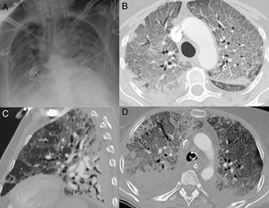 Patrón radiológico de daño alveolar difuso en pacientes con COVID-19. A) Opacificación completa de ambos pulmones con broncograma aéreo. B) Extenso patrón “en empedrado” con pequeños focos consolidativos de predominio posterior en paciente con 10 días de síntomas, que requiere ingreso en la unidad de cuidados intensivos. C) Reconstrucción sagital donde se identifica el típico gradiente gravitacional con consolidaciones en zonas declives, opacidades “en vidrio deslustrado” y patrón “en empedrado” en zonas intermedias, con áreas relativamente respetadas en las zonas no declives. D) Imagen axial con gradiente gravitacional, consolidaciones de predominio en zonas dependientes y extenso patrón “en empedrado” anterior. Se observa derrame pleural bilateral, mucho más frecuente en pacientes con enfermedad grave.