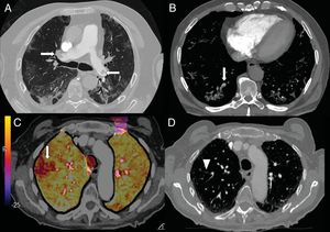 A) Varón de 73 años con embolia pulmonar central bilateral (flechas). B) Varón de 77 años con COVID-19 y embolia pulmonar segmentaria en relación con consolidación en lóbulo inferior derecho, que sugiere trombosis vascular (flecha). C y D) Mujer de 89 años con COVID-19 y elevación del dímero D. Se realizó una angio-TC con mapa de yodo por sustracción, que mostraba un defecto de perfusión periférico (flecha) que se correlaciona con sutil defecto de repleción segmentario y subsegmentario en lóbulo superior derecho (punta de flecha).