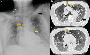 Varón de 67 años con extensa afectación bilateral por COVID-19 y grave insuficiencia respiratoria. Llama la atención en la radiografía de tórax portátil (A) un enfisema subcutáneo supraclavicular derecho (flecha curva), neumomediastino (flechas naranjas) y neumotórax apical izquierdo (flecha negra). En las imágenes B y C de la tomografía computarizada torácica se confirman todos los hallazgos y se visualiza adicionalmente neumorraquis (punta de flecha azul).
