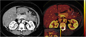 Pancreatitis aguda en imágenes | Radiología