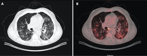 Varón de 71 años con antecedente de carcinoma de colon, donde en un control se apreció un nódulo pulmonar indeterminado. A) Imagen de tomografía computarizada (TC) con ventana de pulmón. B) Imagen de fusión PET/TC que muestra aumentos de densidad bilaterales característicos de COVID-19, los cuales muestran captación metabólica.