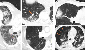 Otros patrones radiológicos de tomografía computarizada en pacientes con COVID-19: A) Patrón “en empedrado” (crazy paving). B) Engrosamiento vascular en el interior de las lesiones. C) Signo del halo. D) Vacuolización. E) Signo del halo invertido. F) Neumotórax espontáneo.