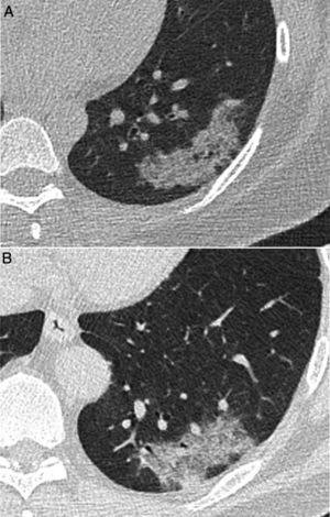 Imágenes de tomografía computarizada (TC) correspondientes a 2 pacientes con lesiones de apariencia radiológica similar: A) Mujer de 40 años con esclerosis sistémica limitada y tos, con consolidación pulmonar persistente en lóbulo inferior izquierdo durante más de 9 meses y diagnóstico anatomopatológico concordante con seudotumor inflamatorio. B) Varón de 52 años que acude durante las fechas de la pandemia de COVID-19 con fiebre elevada persistente y disnea de 4 días de evolución. Debido a la persistencia de los síntomas tras una PCR negativa, se realiza una TC que mostró una consolidación de apariencia similar a imagen A, finalmente diagnosticada de neumonía por SARS-CoV-2 tras confirmación por una nueva PCR.