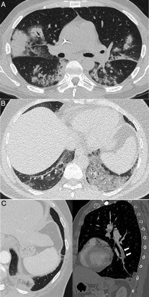 Procesos pulmonares con confirmación clínica y patológica que ocurren en contextos clínicos característicos, pero de apariencia similar a la neumonía COVID-19. A) Síndrome de diferenciación secundario al tratamiento con ácido transretinoico en un paciente con leucemia promielocítica aguda que muestra consolidaciones bilaterales asociadas a algunas zonas de atenuación “en vidrio deslustrado” y opacidades nodulares. B) Neumonía lipoidea exógena que se manifiesta como áreas de atenuación “en vidrio deslustrado” denso en ambas bases pulmonares. C) Paciente con sospecha de COVID-19, pero finalmente diagnosticado de tromboembolismo pulmonar con infarto pulmonar, que mostraba un halo invertido y un defecto de repleción en rama del lóbulo inferior izquierdo, mostrado en la reconstrucción sagital (flechas).
