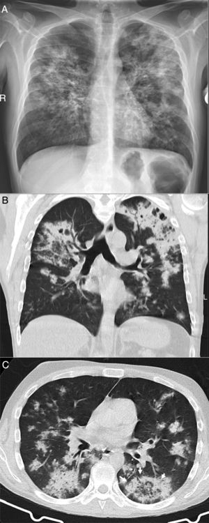 Varón de 39 años que acude durante la pandemia por astenia, mialgias y odinofagia, con diagnóstico final de tuberculosis pulmonar. La radiografía de tórax (A) muestra consolidaciones bilaterales extensas de predominio superior y central en el lado derecho y en campos superior y medio en el lado izquierdo, con posibles cavitaciones que se confirman en la reconstrucción coronal de la TC (B). Son visibles también opacidades con morfología de árbol en brote y alguna lesión con apariencia de halo invertido, cuyos bordes micronodulares son una característica distintiva de la enfermedad (flechas en C).