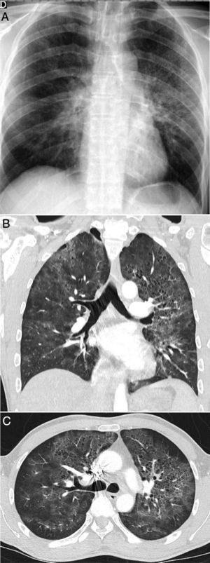 Varón de 42 años, sin antecedentes de interés, que acude durante la pandemia por fiebre y disnea de 3 semanas de evolución acompañadas de hipoxemia, linfopenia y elevación de dímero D y LDH. La radiografía de tórax (A) muestra opacidades pulmonares de predominio perihiliar y en los dos tercios superiores de los pulmones, con pequeñas imágenes quísticas en el lado izquierdo. Una angio-TC para descartar tromboembolismo pulmonar (B y C) mostró la presencia de opacidades de atenuación “en vidrio deslustrado” con discreto predominio superior y tendencia a respetar la periferia pulmonar, acompañadas de lesiones quísticas aéreas de paredes finas. Se sospechó que se trataba de una neumonía por Pneumocystis jirovecii, que fue confirmada por lavado broncoalveolar y posteriormente se confirmó positividad para el virus de la inmunodeficiencia humana.