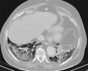 Tomografía computarizada, realizada durante la pandemia a un anciano con fiebre y nivel de conciencia fluctuante, que muestra consolidaciones posterobasales bilaterales con respeto subpleural. Se sospechó aspiración. El cuadro clínico y radiológico se resolvió con antibióticos y se descartó COVID-19 durante el ingreso.