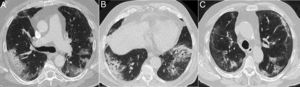 Neumonitis secundaria a toxicidad farmacológica, cuya presentación clínica y alteraciones parenquimatosas pueden simular la neumonía COVID-19. A) Paciente con carcinoma de colon en tratamiento con el esquema FOLFOX (ácido folínico, fluorouracilo y oxaliplatino). B) Carcinoma de células renales en tratamiento con everolimus. C) Paciente con neoplasia pulmonar con mutación ALK tratada con alectinib, que acudió durante la pandemia por disnea, descartándose COVID-19 y otras causas para las lesiones.