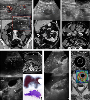 Tumores neuroendocrinos. A) Tumor carcinoide de íleon terminal. Mujer de 62 años con vómitos y dolor abdominal. Antecedente de macroadenoma hipofisario intervenido. Imagen superior: ecografía. Imagen inferior: tomografía computarizada (TC) coronal. Lesión nodular hipoecogénica con abundante vascularización en Doppler y TC (flechas), en el ángulo interno de tramo plegado de íleon distal (+), con peristaltismo ineficaz a tiempo real (vídeo 2). Además, adenopatías hipoecogénicas y vascularizadas (cabezas de flecha) en meso regional tumefacto y ecogénico (m). Se diagnostica MEN-1. En el recuadro: implante endometriósico (*) en íleon terminal (+) en otra paciente, como nódulo hipoecogénico que infiltra la serosa, retrayendo el asa y respetando las capas profundas, que muestra hallazgos similares y con el que hay que establecer diagnóstico diferencial (no vascularizado y sin afectación adenopática en este caso). B) Carcinoide ileal solo manifestado como masa mesentérica. Imagen superior: biopsia percutánea (flechas huecas) guiada ecográficamente de nódulo mesentérico hipoecogénico (flecha), que demostró metástasis ganglionar de tumor neuroendocrino. Imagen inferior: TC coronal con contraste oral e intravenoso. Nódulos adenopáticos mesentéricos (flechas). En la cirugía se identificó un carcinoide milimétrico intestinal primario y retrospectivamente podría corresponder al pequeño defecto de repleción indicado por la cabeza de flecha. C) Carcinoides yeyunales múltiples y metástasis ganglionares mesentéricas. Mujer de 71 años con molestias abdominales inespecíficas. Imágenes superiores: ecografías. Centrales e inferiores: imágenes axiales de entero-TC en dos planos diferentes. Se detectan hasta 5 tumores hipoecogénicos e hipervasculares (uno no mostrado) en tramos plegados de yeyuno (flechas), con un pequeño conglomerado adenopático también hipervascular e hipoecogénico en el meso tributario (cabezas de flecha). D) Síndrome de Zollinger-Ellison por tumor neuroendocrino de tipo II (gastrinoma) de tracto digestivo superior. Varón de 44 años con vómitos, diarrea y shock. Imagen izquierda: ecografía. Imagen derecha superior: TC axial. Abundante líquido en estómago (e), duodeno (d) y yeyuno proximal (no mostrado), con marcado engrosamiento de pliegues gástricos (cabezas de flecha). Medial al duodeno y posterior al páncreas se ve un nódulo hipervascular y levemente ecogénico (flechas) en el seno de una estructura ganglionar. Esta región está dentro del llamado “triángulo del gastrinoma”. Derecha centro: gammagrafía con octeótrida. Se confirma captación por parte del nódulo (flecha). También hay hipergastrininemia. Derecha inferior: pieza quirúrgica del gastrinoma (flechas) en el seno de un ganglio. E) Carcinoma neuroendocrino gástrico de tipo III. Varón de 59 años con síndrome constitucional. La ecografía muestra abundantes metástasis hepáticas (m) y, empleando el bazo (b) como ventana acústica, un tumor infiltrante en la curvatura mayor del estómago. Se sospechó un adenocarcinoma, pero la biopsia endoscópica demostró un carcinoma neuroendocrino. F) Tumor neuroendocrino rectal. Hallazgo en la colonoscopia por test de sangre oculta en heces positivo en varón de 62 años. Imagen superior: ecografía transrectal. Imagen inferior: RM T2 axial. Tumor de 7× 5 mm (flechas) con comportamiento hipoecogénico e hipointenso en T2, situado en la parte profunda de la capa submucosa del recto inferior, con moderada rigidez tisular en elastografía (recuadro central), con strain ratio de 10 con respecto a la pared rectal normal. Se realizó una resección endoscópica transanal.