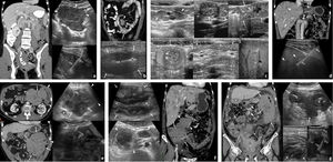 Linfomas gastrointestinales. A) Linfoma difuso de células grandes de íleon terminal. Mujer de 36 años. Imagen izquierda: tomografía computarizada (TC) coronal con contraste oral e intravenoso. Imagen derecha: ecografía. Engrosamiento mural hipoecogénico e hipovascular marcado en un tramo largo de íleon distal (flechas) cuya luz se encuentra dilatada (*). Se acompaña de una masa mesentérica adyacente de ecogenicidad similar (cabezas de flecha), sobre la que se realizó BAG guiada ecográficamente (flechas huecas). B) Linfoma difuso de células grandes de yeyuno distal. Varón de 70 años. Imagen superior: TC coronal con contraste oral e intravenoso. Imagen inferior: ecografía. Engrosamiento mural hipoecogénico e hipovascular marcado en un tramo más corto de yeyuno distal (flechas), también con dilatación aneurismática (*) y una masa mesentérica adenopática acompañante (cabeza de flecha). El diagnóstico se consiguió con la biopsia percutánea del engrosamiento intestinal (no mostrado). C) Enfermedad inmunoproliferativa de intestino delgado (o “linfoma mediterráneo”, subtipo de linfoma extranodal de la zona marginal). Varón de 17 años con diarrea, fiebre y dolor abdominal. La ecografía muestra adenopatías mesentéricas homogéneas (cabezas de flecha), engrosamiento de pliegues de yeyuno proximal (flechas), con una invaginación larga de yeyuno (flechas discontinuas) con mesenterio en su interior (m), así como pequeñas lesiones focales hepáticas hipoecogénicas (flechas huecas). El diagnóstico se obtuvo con la biopsia de dos lesiones focales hepáticas (no mostrado). D) Linfoma T gástrico de alto grado asociado a enteropatía. Varón de 61 años con diagnóstico de enfermedad celiaca. Imagen superior: TC. Imagen inferior: BAG guiada ecográficamente. Engrosamiento circunferencial hipovascular e hipoecogénico (no mostrado) de antro gástrico (flechas), con múltiples lesiones focales hepáticas hipocaptantes (cabezas de flecha) y levemente hipoecogénicas. En la gastroscopia se ve una lesión antral ulcerada, pero las biopsias son repetidamente negativas. El diagnóstico se consigue con la biopsia percutánea de las lesiones hepáticas. E) Linfoma folicular de bajo grado de yeyuno proximal. Varón de 73 años. Imagen izquierda: TC axial (superior) y coronal MIP fino (inferior). Imagen derecha: ecografía, corte transversal (superior) y biopsia percutánea. Engrosamiento mural excéntrico de un tramo de yeyuno proximal (cabezas de flecha) con una gran masa mesentérica (flechas) que se extiende hasta el ángulo de Treitz (t), con escaso efecto de masa sobre los vasos mesentéricos a su través. a: aorta. Ecográficamente se define mejor la heterogeneidad de este conglomerado adenopático, lo que permite dirigir la biopsia percutánea a la parte más sólida de la masa mesentérica (flechas huecas). Persiste en remisión completa tras 3 años de iniciar la quimioterapia. F) Linfoma de Burkitt ileocecal. Mujer de 46 años. Imagen izquierda: ecografía. Imagen derecha: TC coronal. Engrosamiento mural importante, excéntrico, en la región ileocecal (flechas) sin estenosis de la luz (*) y con cierta sensación de preservación de la estructura ecográfica en capas a pesar de la magnitud del engrosamiento. Se acompaña de un conglomerado adenopático mesentérico (cabezas de flecha) que se define con más precisión en la ecografía, así como numerosas lesiones focales hepáticas (flechas discontinuas) y ascitis (+). Persiste en remisión completa tras 4 años de iniciar la quimioterapia. G) Linfoma de células del manto de alto grado con afectación de ángulo esplénico del colon. Mujer de 69 años. Imagen izquierda: TC coronal. Imagen derecha: ecografía. Gran masa que engloba el ángulo esplénico del colon (c) y se extiende hacia su meso (flechas). Se acompaña de afectación de íleon distal (i), vesícula (v) y útero (u) como engrosamiento visceral, así como adenopatías mesentéricas (cabezas de flecha), ascitis (+) y linfomatosis peritoneal (flechas discontinuas). El diagnóstico se obtuvo con biopsia percutánea ecodirigida de la masa del mesocolon (flechas huecas).