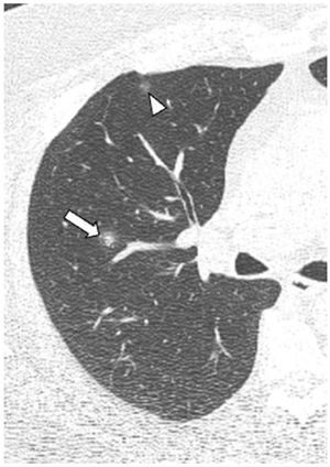 Tomografía computarizada de tórax de un paciente de 44 años con COVID-19 en la fase precoz de la enfermedad. Se observa una opacidad nodular con signo del “halo” en el lóbulo superior derecho (flecha). También se identifica una opacidad en vidrio deslustrado más anterior (cabeza de flecha).