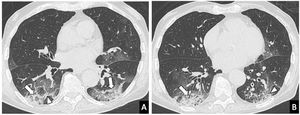 Tomografía computarizada de tórax en un varón de 83 años con COVID-19 y con síntomas desde hace 15 días (fase avanzada de la enfermedad). A y B) Imágenes axiales que muestran opacidades en vidrio deslustrado con consolidación (flechas) y patrón reticular con engrosamiento de los septos interlobulillares (cabezas de flecha) con distribución periférica.