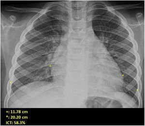 Cardiomegalia y patrón intersticial peribronquial. Radiografía de tórax en la que se observa aumento del índice cardiotorácico por cardiomegalia y engrosamiento peribronquial y patrón intersticial perihiliar como signos de insuficiencia cardíaca.