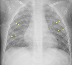 Engrosamiento peribronquial y patrón intersticial perihiliar (flechas), como signos de insuficiencia cardíaca.