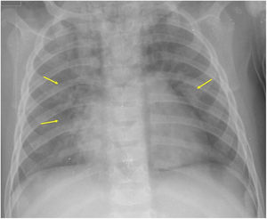 Consolidaciones perihiliares (flechas) correspondientes a edema pulmonar cardiogénico.