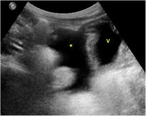 Ascitis. Imagen de ecografía abdominal en la que se observa líquido libre (asterisco) de localización posterior a la vejiga (V).