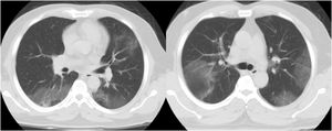 Dos TC axiales de tórax con ventana pulmonar sin contraste demuestran GGO multifocal en ambos pulmones en un paciente con neumonía por COVID-19.