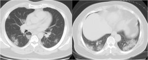 Dos TC axiales de tórax con ventana pulmonar sin contraste demuestran opacidades consolidativas irregulares multifocales en ambos campos pulmonares en un paciente con neumonía por COVID-19.