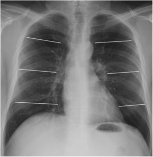 Radiografía de tórax posteroanterior que muestra la división en 8 campos pulmonares mediante tres líneas horizontales (sistema de cuantificación 8). Campo pulmonar superior (de vértices al borde superior del botón aórtico), campo pulmonar medio hiliar (desde botón aórtico a hilios), campo pulmonar medio paracardíaco (desde hilios hasta tercio inferior de la silueta cardíaca), campo pulmonar inferior (desde tercio inferior de silueta cardíaca hasta senos costofrénicos).