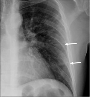 Mujer de 52 años con infección por SARS-CoV-2. Detalle de la radiografía de tórax posteroanterior que muestra dos opacidades lineales periféricas (flechas).