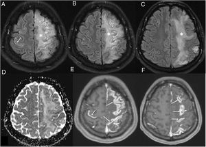 Mujer de 36 años ingresada por neumonía por COVID-19 que presenta un déficit neurológico agudo en el hemicuerpo derecho. La resonancia magnética cerebral muestra una alteración difusa corticosubcortical frontoparietal izquierda (asteriscos en A-C) y prefrontal derecha (flecha en A) en las imágenes T2-FLAIR, sin restricción en el mapa del coeficiente de difusión aparente (D), que se asocia con un intenso realce leptomeníngeo en las imágenes T1 con contraste (flechas en E-F). Se orientó como una meningoencefalitis.