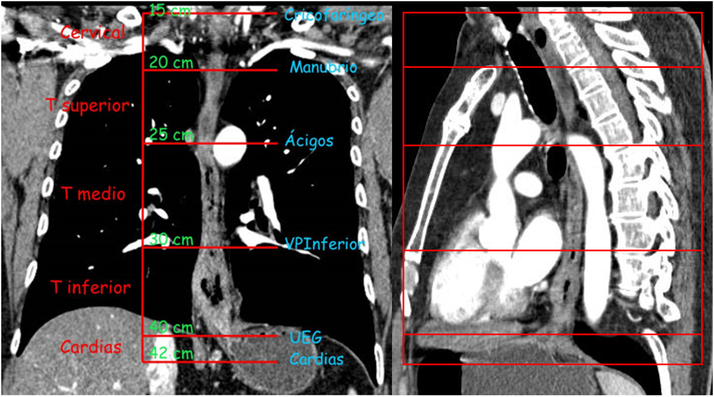 Radiografia De Cancer De Esofago Puedo Tener C ncer De Est mago Y No