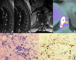 A-B) Secuencias T1 y T2 de resonancia magnética de columna dorsal en plano sagital. C) T1 FAT-SAT en plano axial. D) Imagen axial de PET-TC con 18F-FDG. E-F) Imágenes histológicas con hematoxilina-eosina y tinción para IgG4. En las imágenes A-C se muestra la masa de partes blandas mediastínica posterior y en el espacio retrocrural (estrellas blancas), heterogénea y de intensidad intermedia, sin evidencia de infiltración ósea. En la imagen D se identifica una actividad hipermetabólica en la masa mediastínica (estrella negra) y en la crura diafragmática derecha (asterisco negro), compatible con infiltración. Las imágenes histológicas demuestran focos de plasmocitosis policlonal (flechas negras) y positividad de las células para IgG4 (puntas de flecha). “el lector puede ver la figura a color en la versión online”.