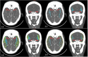 Representación de la disposición espacial/anatómica aproximada de los segmentos de la arteria cerebral media en cortes axiales y sagitales de tomografía computarizada. 2.1) Segmento M1 en rojo. 2.2) Segmento M2 en azul. 2.3) Segmento M3 en verde. 2.4) Segmento M4 en amarillo.