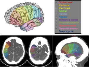 Imagen en 3D cerebral con los territorios de irrigación correspondientes a cada una de las ramas corticales y representación de la disposición espacial/anatómica aproximada de las distintas ramas corticales en cortes axiales y sagitales de tomografía computarizada con sus territorios de irrigación correspondientes.