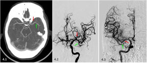 Ejemplos de angio-TC (4.1) y angiografía digital (4.2 y 4.3) con ramas precoces (flechas rojas) emergiendo previas a la bifurcación de la arteria cerebral media (flechas verdes).