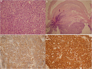 a) Infiltración de células plasmáticas (HE ×100). b) Las células plasmáticas presentaban núcleos excéntricos con cromatina gruesa (HE ×400). c) Tinción de CD138 (DAB ×200). d) Tinción de lambda (DAB ×200).
