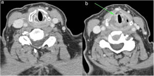 a) La tomografía computarizada mejorada con contraste del cuello después del tratamiento reveló unas cuerdas vocales normales. b) También se observaron cambios posteriores a la radioterapia en la zona subglótica.