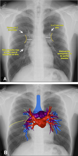 Anatomía hiliar en radiografías de tórax posteroanteriores. 1 A) Se muestra la forma de “C” de los hilios con convexidad externa y atenuación similar a las partes blandas. 1 B) Reconstrucción volumétrica de tomografía computarizada superpuesta a la radiografía, en donde se visualizan la vía aérea (azul), venas (rojo) y arterias pulmonares (morado). Además, se visualizan la formación del ángulo venolobar (línea amarilla punteada) y la cisura menor (línea amarilla continua).