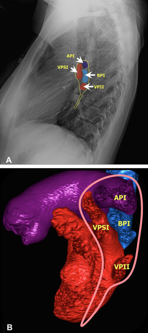 Anatomía del hilio izquierdo. 3 A) Radiografía de tórax en proyección lateral que ilustra las relaciones anatómicas normales de venas, arteria y bronquio. 3 B) Reconstrucción volumétrica de tomografía computarizada. Se delimita la inserción pleural del hilio izquierdo (línea rosada) para visualizar sus relaciones anatómicas. La arteria pulmonar por encima del bronquio (epiarterial), mientras que la vena pulmonar superior izquierda (VPSI) se localiza delante de estas. API: arteria pulmonar izquierda; BPI: bronquio principal izquierdo; VPII: vena pulmonar inferior izquierda.