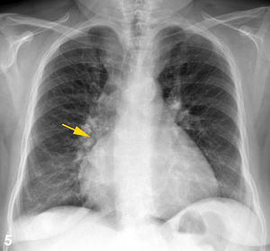 Radiografía posteroanterior de tórax de una mujer de 64 años con cardiomegalia dependiente de cavidades derechas que provoca desplazamiento de la arteria interlobar derecha sin sobreponerse a ella (flecha amarilla).