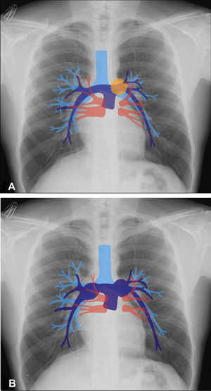 Signo de convergencia hiliar. 8 A) Esquema que muestra una masa localizada en posición extrahiliar izquierda (óvalo naranja). Se observa cómo las ramas de la arteria pulmonar son visibles a través de la opacidad y convergen hacia el corazón, lo que indica que la opacidad se debe a una masa mediastínica con relación anterior o posterior al hilio. 8 B) Esquema que muestra agrandamiento de las arterias pulmonares, donde sus ramas terminan en las prominencias hiliares de origen vascular.