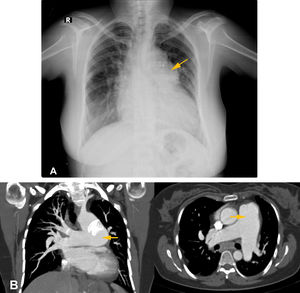 Síndrome de Eisenmenger en mujer de 37 años con persistencia de un conducto arterioso. 9 A) Radiografía posteroanterior de tórax que muestra abultamiento del hilio izquierdo con vasos que conducen hacia la protuberancia “anormal” (flecha amarilla). 9 B) Angiografía por tomografía computarizada en planos axial y coronal que confirman su origen vascular (flechas amarillas).