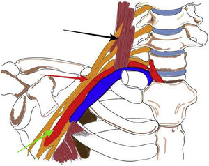 Anatomía del estrecho torácico superior. Espacios interescaleno (flecha negra), costoclavicular (flecha roja) y retropectoral (flecha verde).