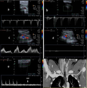 A) Flujo arterial normal en posición neutra de la arteria subclavia. B) Duplicación de la Vps en la arteria subclavia en la abducción a 90° en el síndrome del estrecho torácico (SET). C) Flujo venoso normal en posición neutra de la vena subclavia. D) Pérdida de la dinámica respiratoria en la vena subclavia con las maniobras de abducción en el SET. E) Onda arterial radial normal en posición neutra y atenuada con la maniobra de Adson en el SET. F) Tomografía computarizada con contraste, en proyección coronal, donde se observa compresión de arteria subclavia izquierda en la región costoclavicular.