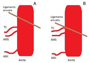 En la figura A se muestra la anatomía normal. En la figura B se muestra cómo el ligamento arcuato contacta con la salida del tronco celiaco. AMI: arteria mesentérica inferior; AMS: arteria mesentérica superior; TC: tronco celiaco.