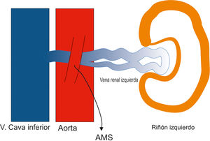 Anatomía del síndrome de cascanueces. AMS: arteria mesentérica superior.