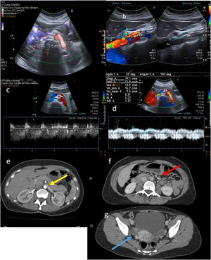 A) Calibre de la vena renal izquierda (VRI) en región hiliar (antes de la pinza): 12,2mm. Calibre VRI en la propia pinza entre la aorta (Ao) y la arteria mesentérica superior (AMS): 1,5mm. B) Ángulo aortomesentérico a nivel de VRI disminuido (20°). C) Velocidad de la VRI aumentada en la pinza aortomesentérica (106cm/s). D) Velocidad normal de la VRI previa a la pinza (19cm/s). E-G) Proyecciones axiales de tomografía computarizada de abdomen con contraste en fase arterial (E) y fase portal (F y G). En la imagen E se observa una reducción del calibre de la VRI al pasar por la pinza aortomesentérica (flecha amarilla). En la imagen F se aprecian venas gonadales ligeramente dilatadas (flecha roja). En la imagen G son visibles varices parauterinas derechas (flecha azul).