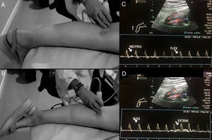 Maniobras de estrés para valoración del síndrome de atrapamiento poplíteo. Paciente en decúbito prono, con la pierna extendida y el tobillo en dorsiflexión (A) y extensión plantar (B) durante 30 segundos. El radiólogo puede ayudar a mantener la postura mediante presión. Se evaluará la presencia, ausencia o cambios en el flujo de todo el recorrido de la arteria poplítea con los cambios de posición. C y D muestran hallazgos normales en Doppler espectral con las maniobras de estrés de flexión y extensión.