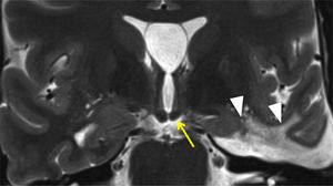 Varón de 43 año intervenido de tumoración temporal izquierda. Las puntas de flecha indican los cambios malácicos posquirúrgicos. La flecha amarilla muestra el adelgazamiento secundario del cuerpo mamilar por degeneración transináptica anterógrada.