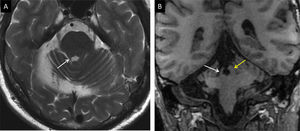 Mujer de 48 años con atrofia cerebelosa por hemorragia. A) Plano transversal potenciado en T2: se identifica el adelgazamiento del pedúnculo cerebeloso superior (flecha blanca) que se confirma en la imagen coronal T1 (flecha blanca en B) al comparar con el contralateral (flecha amarilla).