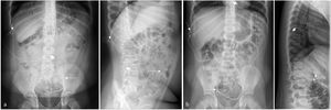 Imagen de la DLP en RX. Radiografías AP en decúbito supino y lateral en bipedestación de abdomen de 2pacientes diferentes (a y b). Flecha corta: extremo lumbar de la válvula; flecha larga: extremo abdominal de la válvula; flecha discontinua: reservorio. La DVP está recién colocada y se identifican las suturas de la entrada al canal espinal y de la colocación subcutánea del reservorio (b).