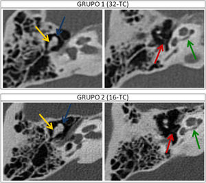 Tomografía computarizada (TC) de peñascos adquiridos en los equipos de 32 y 16 canales, respectivamente, en plano axial, a la altura de la caja timpánica a nivel del martillo (flecha azul) y yunque (flecha amarilla) en las imágenes de la izquierda, y a nivel de estribo (flecha roja) y cóclea (flecha verde) en las imágenes de la derecha. La 32-TCMD obtiene imágenes con calidad adecuada para el diagnóstico, con menor ruido, empleando una dosis de radiación 10 veces menor que la 16-TCMD.