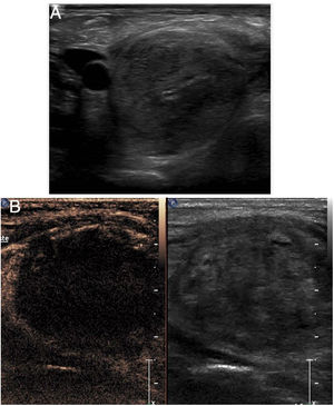 Ablación tiroidea. A) Nódulo tiroideo previo a la ablación. B) Control al mes de la ablación. Puede apreciarse la falta de captación de contraste por el nódulo tratado.